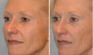 лазерлік биоревитализация